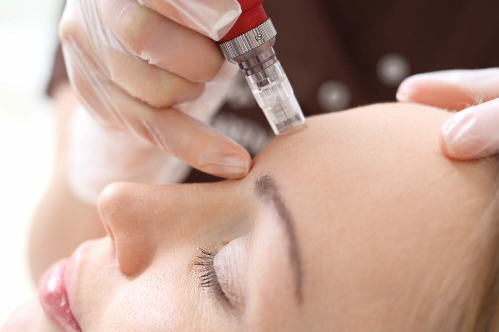 Micro needling bij schoonheidssalon Kalista Assen